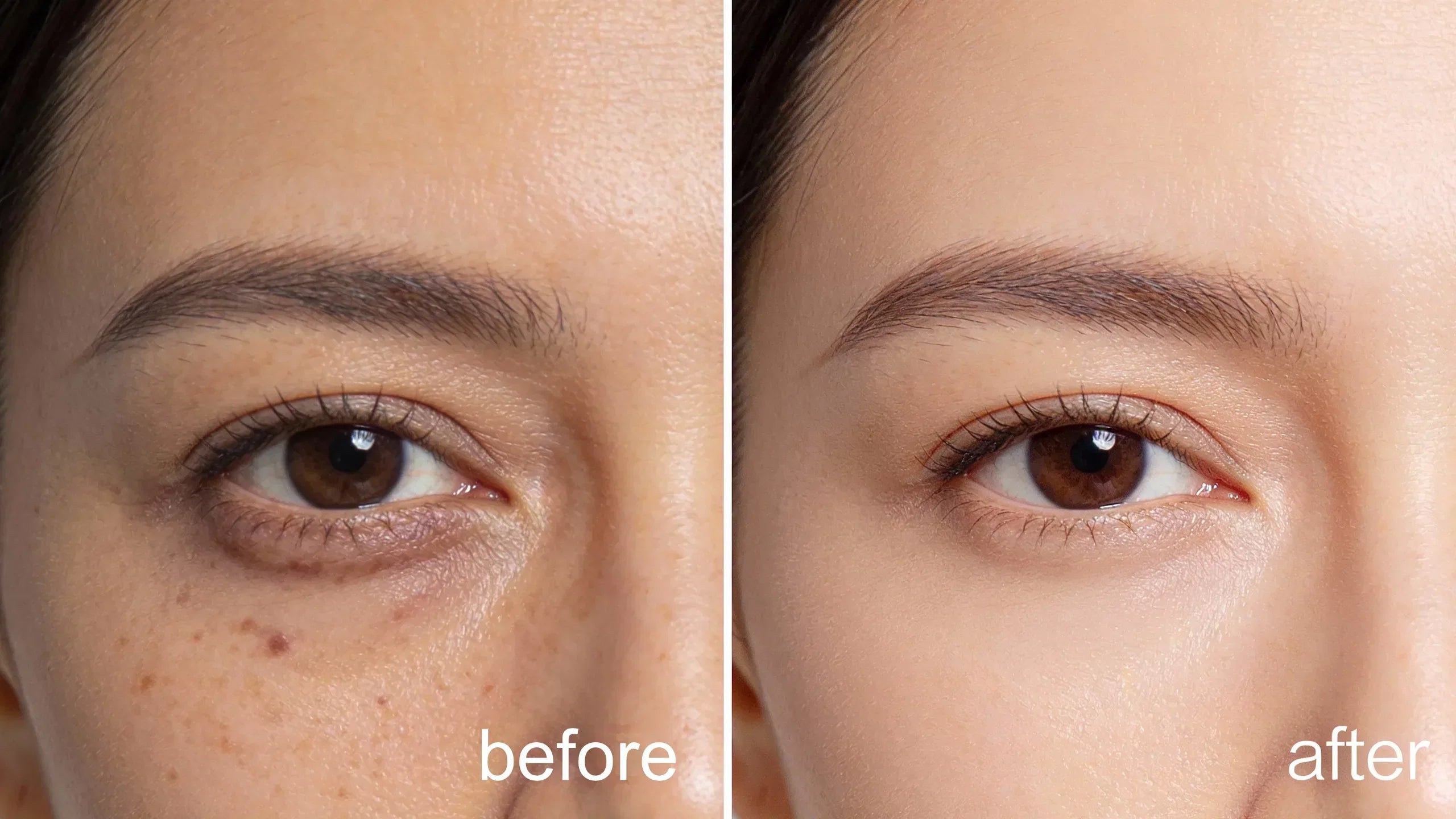 Can You Use a Dermastamp Around the Eyes?